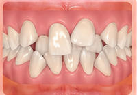 Crowded teeth are harder to clean