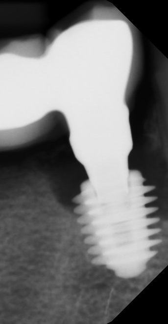 病例 X-ray:种植体周围出现明显骨量丢失。